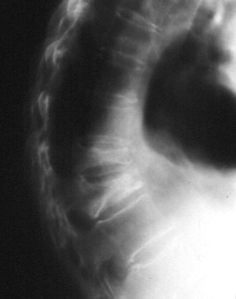 GENOMOS: Weak Links found between COL1A1 Polymorphism, BMD, and Fracture Risk GENOMOS: Weak Links found between COL1A1 Polymorphism, BMD, and Fracture Risk