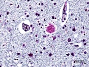 Factors associated with physical aggression among nursing home residents with dementia Factors associated with physical aggression among nursing home residents with dementia