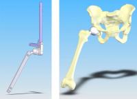 NIST measuring device aims to up hip operation success