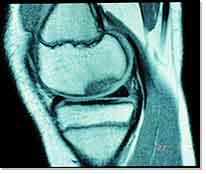 A novel scaffold could improve cartilage repair