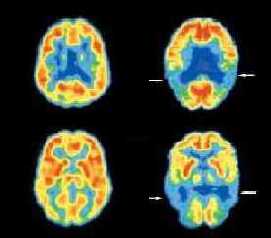 Researchers find missing link between amyloid and tau in Alzheimers disease