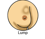 HRT Decline Reduced Breast Cancer Incidence